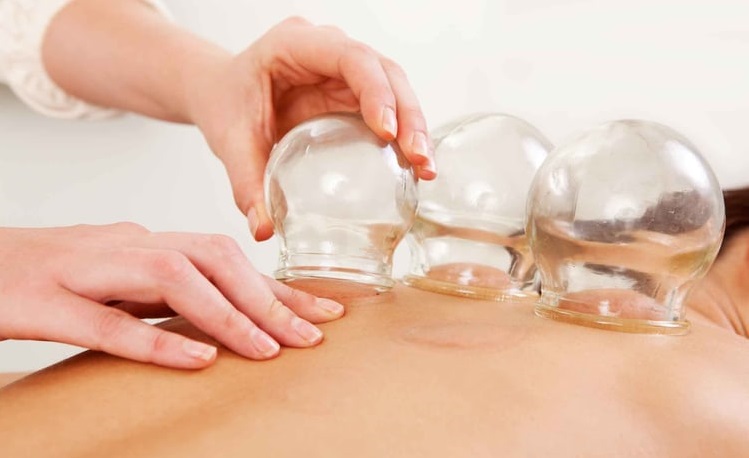 Chinese Cupping Therapy in Singapore: Discover Traditional Healing