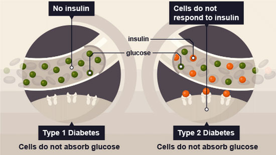 Understanding Type 1 Diabetes: A Comprehensive Guide