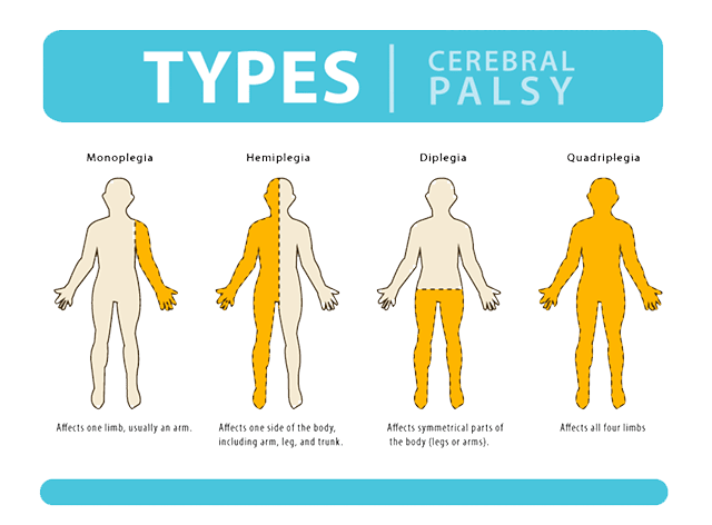 Exploring Stem Cell Therapy as a Promising Treatment for Cerebral Palsy in India