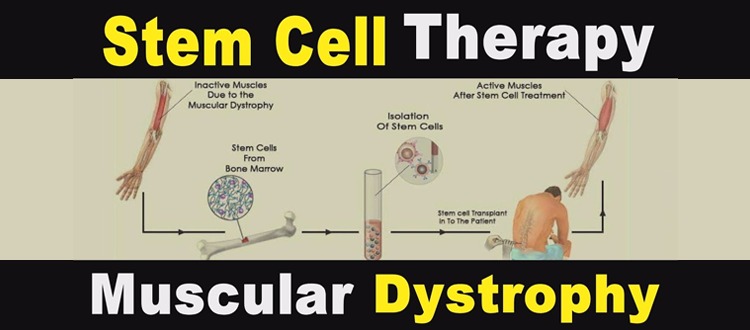 Muscular Dystrophy Stem Cell Therapy India